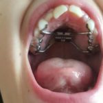 Premier appareil dentaire à 9ans