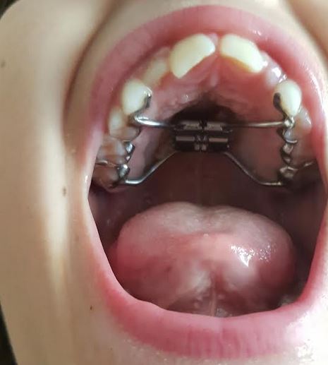 appareil dentaire disjoncteur enfant 9 ans